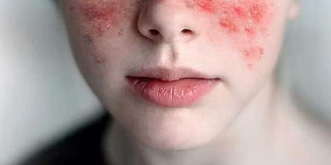 Lack of awareness, support worry lupus patients 