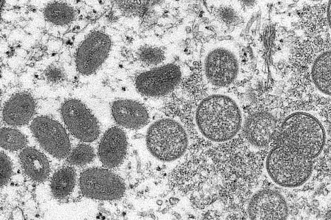This 2003 electron microscope image made available by the Centers for Disease Control and Prevention shows mature, oval-shaped monkeypox virions, left, and spherical immature virions, right. (AP)