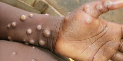 Image of a person affected by monkeypox (Photo | World Health Organisation)