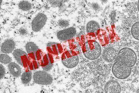 The state reported the first case of monkeypox in the country in a 35-year-old man. (Photo | AP)
