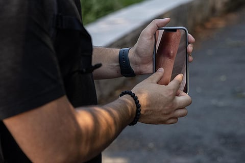 Kyle Planck, 26, who has recovered from monkeypox, shows a photo of a rash on his skin during an interview in New York on July 19, 2022. (Photo | AFP)