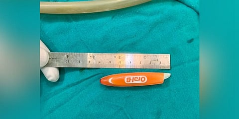 KIMS doctors removed a 7 cm broken toothbrush in Hubballi. (Photo | Express)