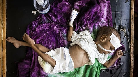Hunger: A severely malnourished baby at the Banadir Maternity and Children Hospital in Mogadishu, Somalia. (Photo | AFP)