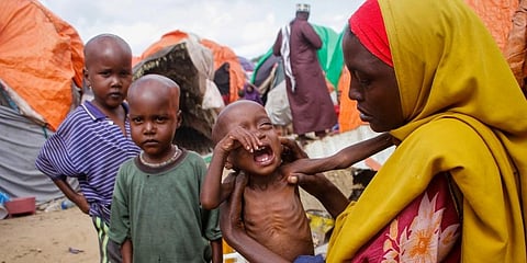 Maryan Madey, who fled the drought-stricken Lower Shabelle region, holds her malnourished daughter Deka Ali, 1, at a camp for the displaced on the outskirts of Mogadishu. (Photo |AP)
