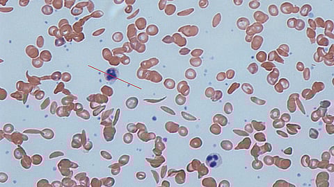 Sickle cells in human blood - both normal red blood cells and sickle-shaped cells are present. (Photo | Wikimedia Commons)