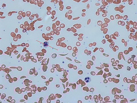 Sickle cells in human blood - both normal red blood cells and sickle-shaped cells are present. (Photo | Wikimedia Commons)