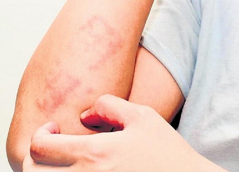 Alleviate allergies this season. (File Photo)