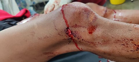 The civilian who was injured in the exchange of fire (Photo | Special arrangement)