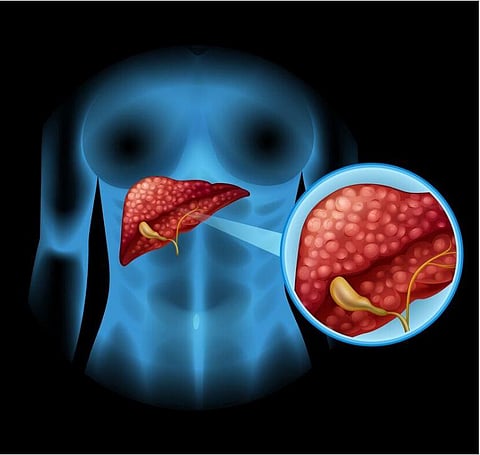 Alcohol linked to higher risk of pancreatic cancer: UN study