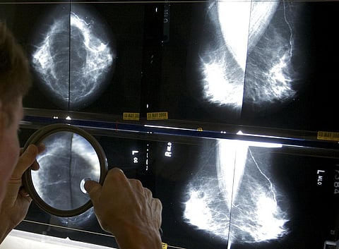 A radiologist uses a magnifying glass to check mammograms for breast cancer | AP