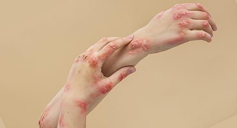 Burn injuries: New treatment protocols improve survival rate