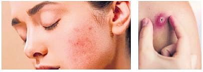 Get rid of heat boils!