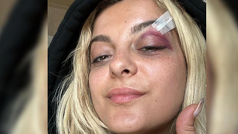 Image shared by Singer Bebe Rexha on her social media after attacked by a fan while performing on stage. (Photo | Instagram)