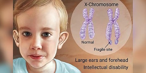 Fragile X