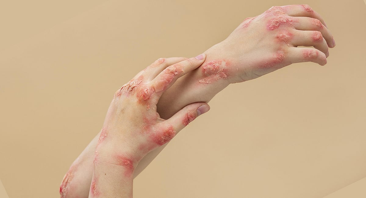 Fire Injuires Burn injuries: New treatment protocols improve survival rate