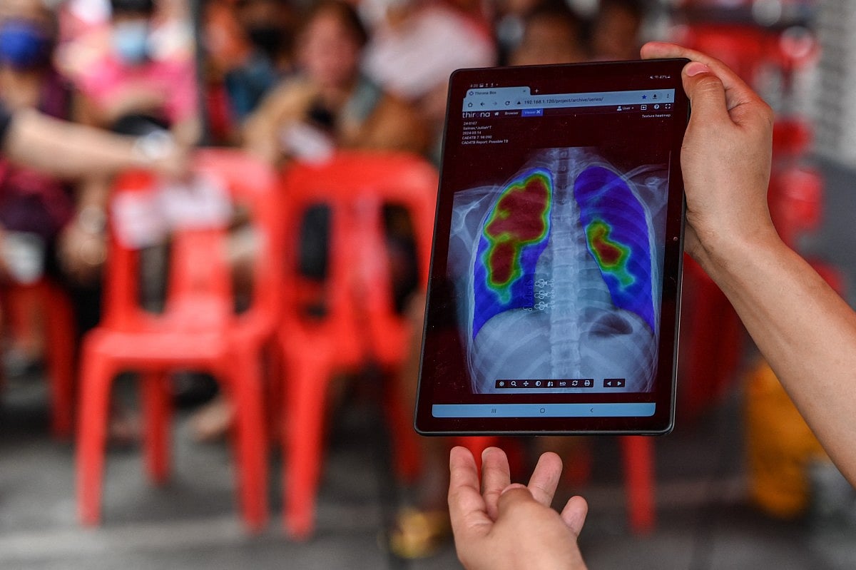 Over 32K living co-infected with HIV and TB in 2024, admits Centre