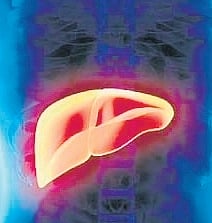 Representative Image of hepatitis A liver infection