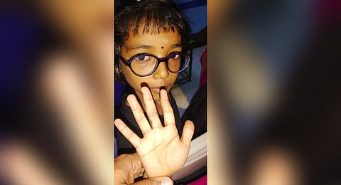 The health condition of the child, Selva Srija of TMB Colony, was under observation for nearly two years after the procedure.