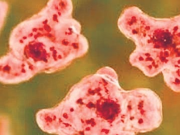 One more amoebic infection case in Kerala; 11-year-old girl critical