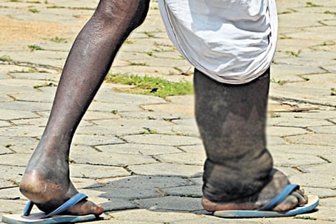 elephantiasis