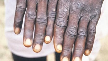 The Mpox, previously known as MonkeyPox is a viral disease caused by the monkeypox virus.