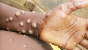 Mpox or Monkeypox, a viral infection with symptoms similar to smallpox