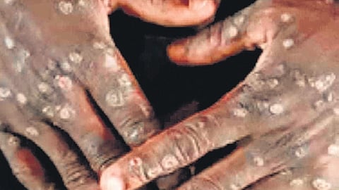 Representative image