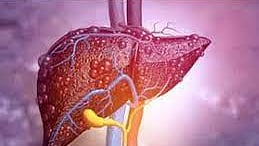 Representative image.