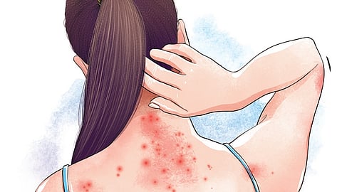 Representative image