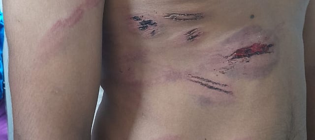 Wounds on Ajay's body from the torture at the call centre.