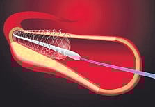 A modern approach to tackle heart disease