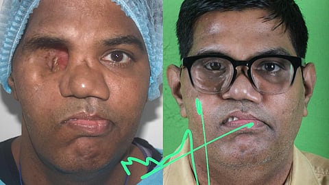 The patient under the treatment, with over a year of follow-up, has shown outstanding functional and aesthetic recovery reinforcing the foreseeable effectiveness of this method.