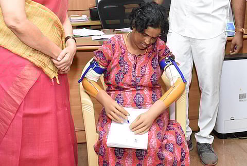 A 32-year-old woman native of Kotagiri in Nilgiris district lost her two hands up to elbows in an electrocution, was treated at Coimbatore Medical College Hospital and fixed customized prosthetic hands