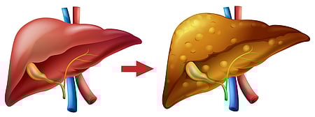 Metabolic Dysfunction-Associated Steatotic Liver Disease (MASLD)
