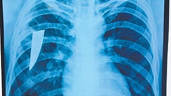 A team of doctors at CTVS department in MKCG medical college and hospital removed a piece of a knife stuck in the chest of a youth since last 3 years. 