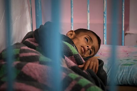 Osama, 5, has cystic fibrosis which has worsened since the start of the war due to the lack of meat, fish and enzyme tablets to help him digest food, at a malnutrition clinic in Nasser hospital, Khan Younis, Gaza Strip, Thursday, May 1, 2025.