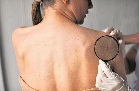 Representative picture of skin cancer
