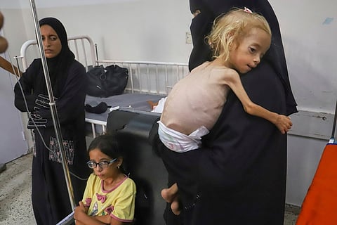 Islam Qudeih holds her severely malnourished shirtless, 2-year-old daughter, Shamm, at Nasser Hospital in Khan Younis, southern Gaza Strip, Saturday, Aug. 9, 2025. Doctors said Shamm may have a genetic disorder that affects muscle and bone development, but there is no way to test for it in Gaza.