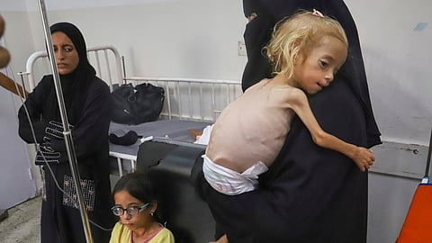 Islam Qudeih holds her shirtless, severely malnourished 2-year-old daughter, Shamm, at Nasser Hospital in Khan Younis, southern Gaza Strip, Saturday, Aug. 9, 2025. Doctors said Shamm may have a genetic disorder that affects muscle and bone development, but there is no way to test for it in Gaza.