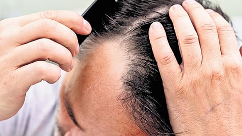 India-US study links hair loss with cholesterol, points to new therapy