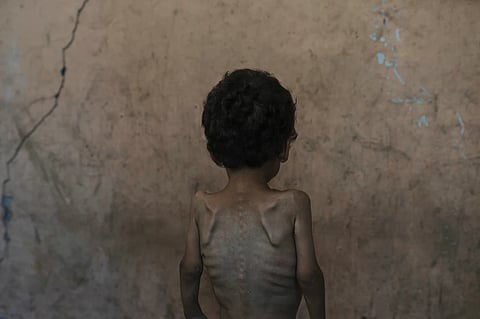 Yazan Abu Ful, a 2-year-old malnourished child, poses for a photo at his family home in the Shati refugee camp, in Gaza City on Wednesday, July 23, 2025.