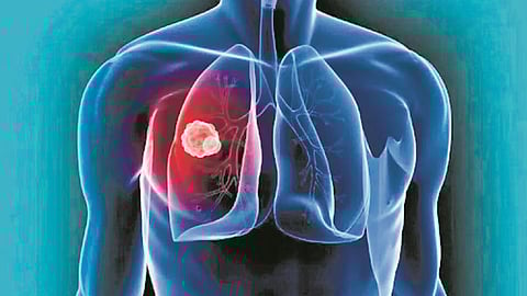 Lung cancer: AI steps into lung care