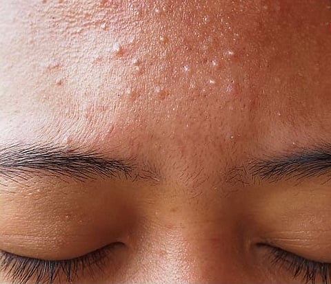 The rise of fungal acne