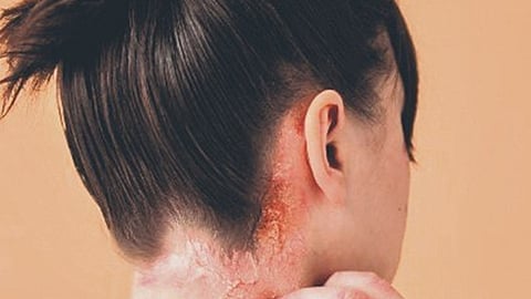 Living on Fragile Skin: Understanding Epidermolysis Bullosa