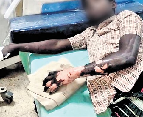 Two classmates allegedly pushed him down, held his hands and legs, and threw him into the burning garbage.