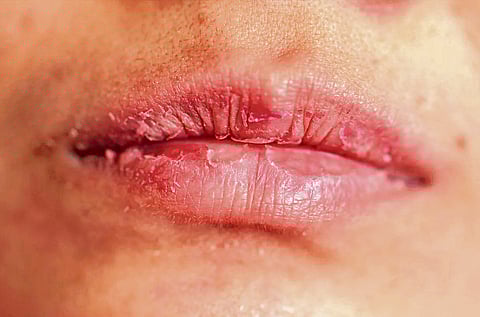 Conditioning Lips Through Cold Weather