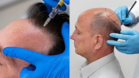 Hair loss treatment