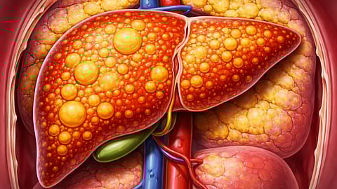 Fatty Liver Disease 