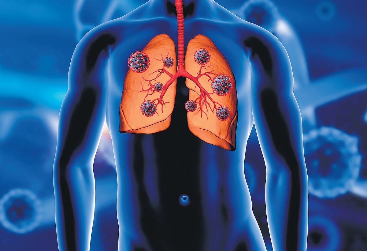 Cystic fibrosis Advancements in care have improved life expectancy