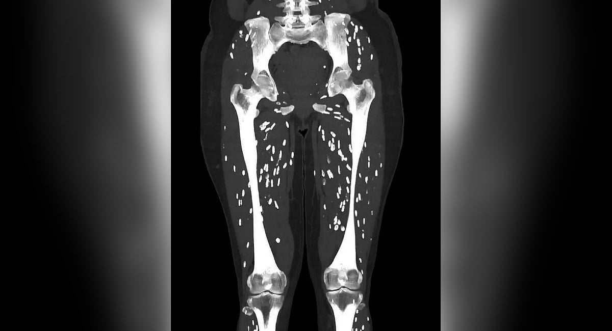 US Doctor warns against eating undercooked pork after sharing CT Scan ...